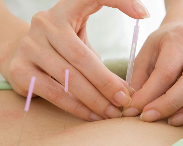 Acupuncture needles