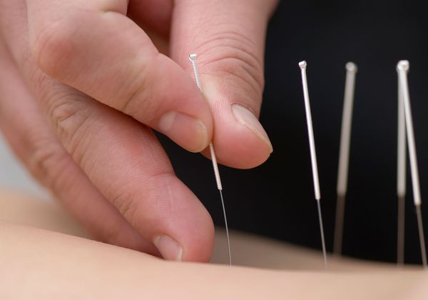 Accupuncture treatment